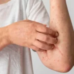 Северный Казахстан: заболеваемость корью снизилась в два раза